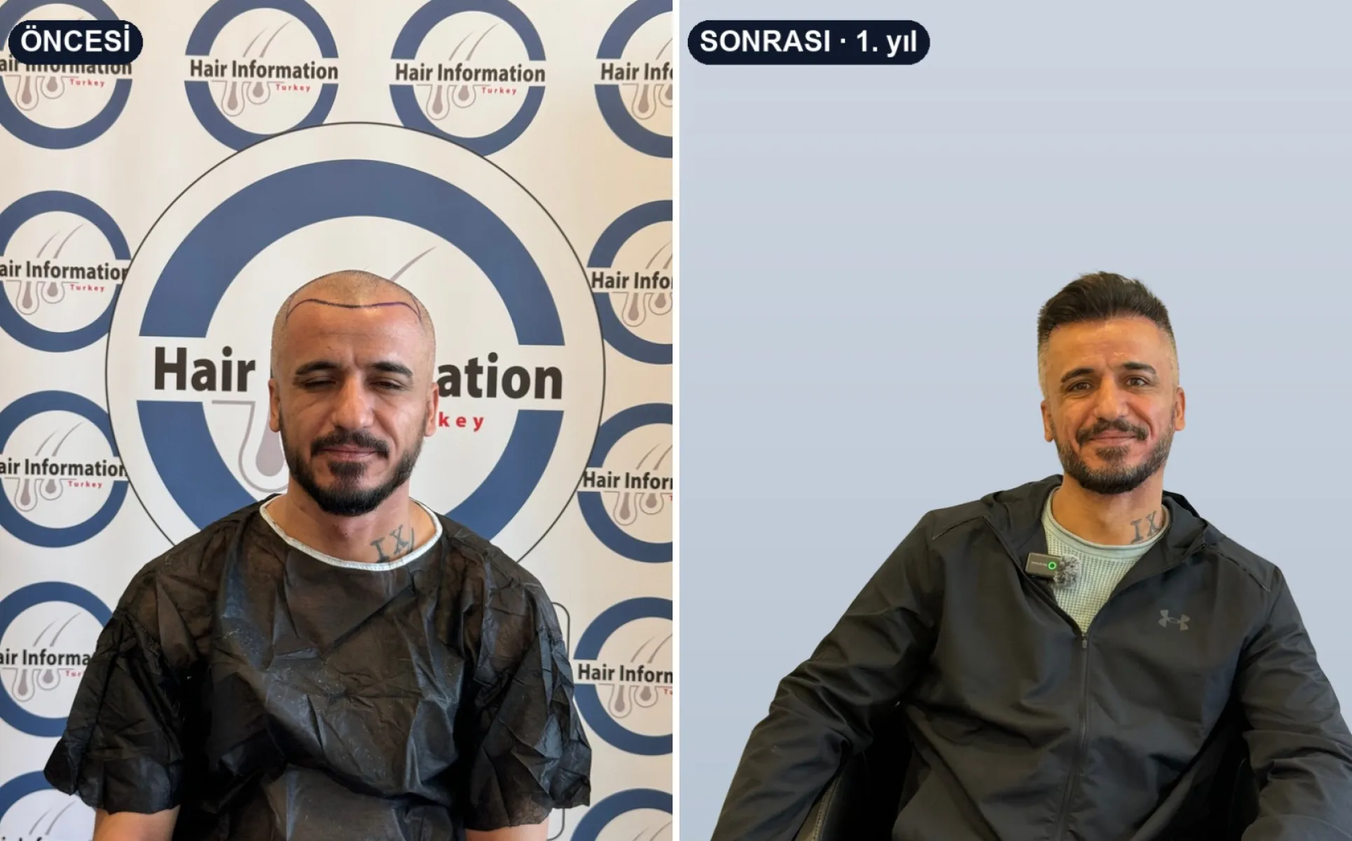 Saç ekimi öncesi ve 1. yıl sonrası — Hair Information Clinic