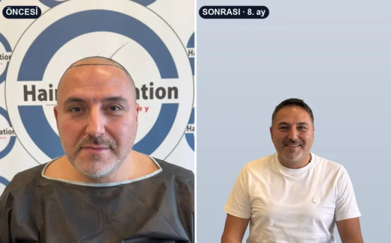 Saç ekimi öncesi ve 8. ay sonrası — Hair Information Clinic
