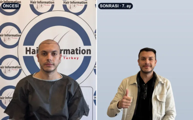 Saç ekimi öncesi ve 7. ay sonrası — Hair Information Clinic